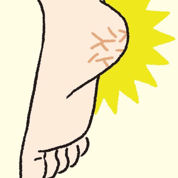 サンダル履きで目立つ、ひび割れたかかと…“かかとのガサガサ”原因＆対策
